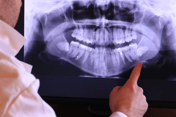Best Emergency Wisdom Tooth Extraction in Lake Clarke Shores, FL